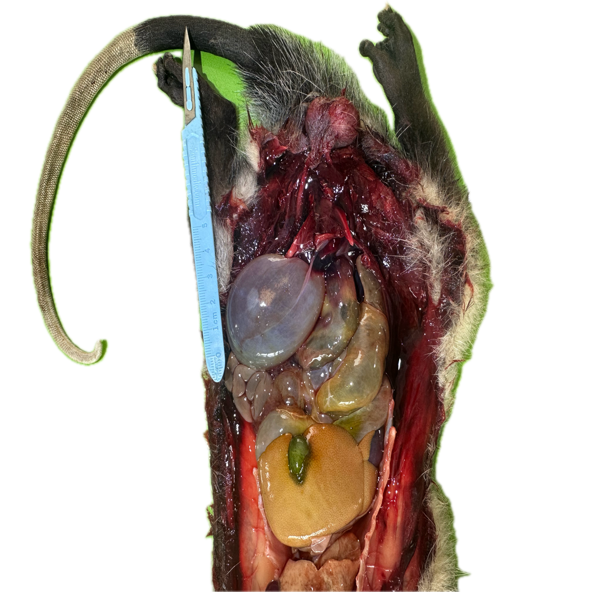Patología Vesical 5