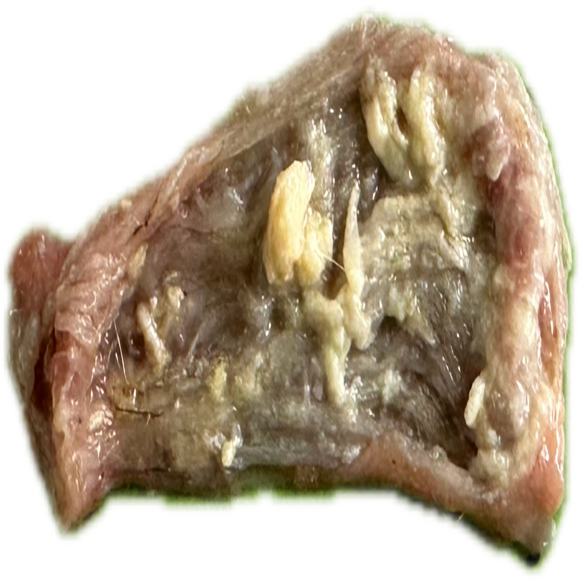 Patología Vesical 9