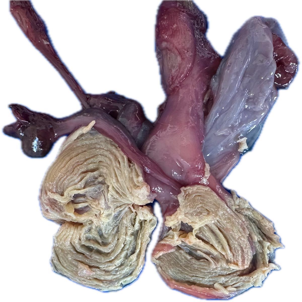 Patología Vesical 10